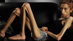 anorexia