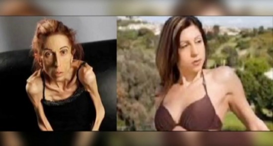 anorexia2