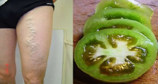 varices-con-tomate